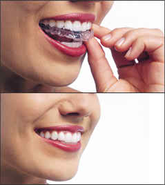 invisalign